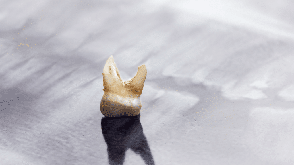 Dente extraído