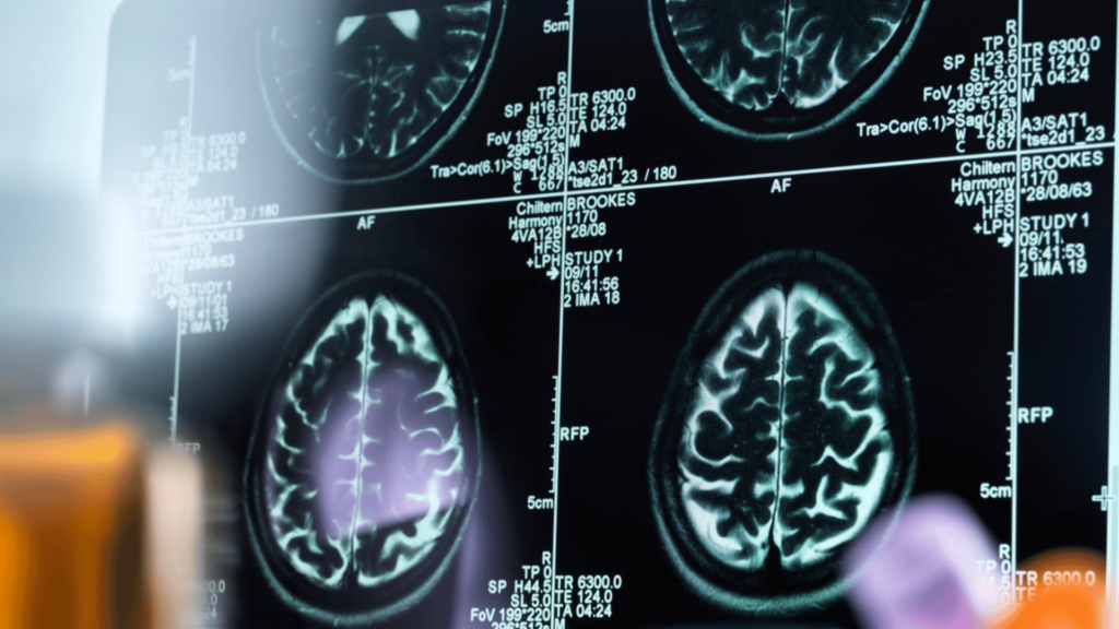 Resultados de exames de neuroimagem na tela do computador.