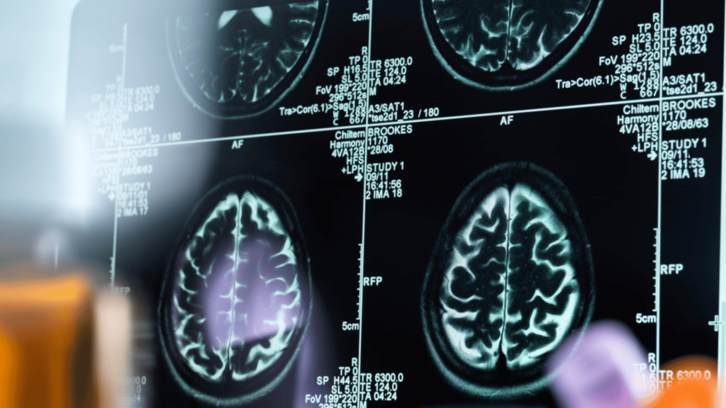 Resultados de exames de neuroimagem na tela do computador. 