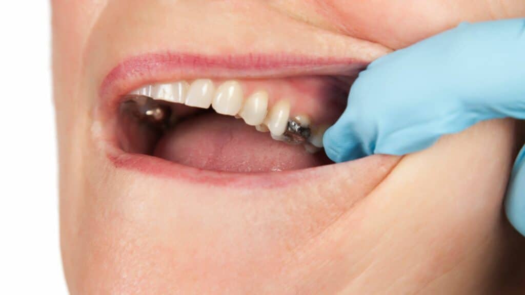 Imagem da boca de uma mulher e da mão da dentista com uma luva azul, mostrando o dente cariado da paciente que está em tratamento.